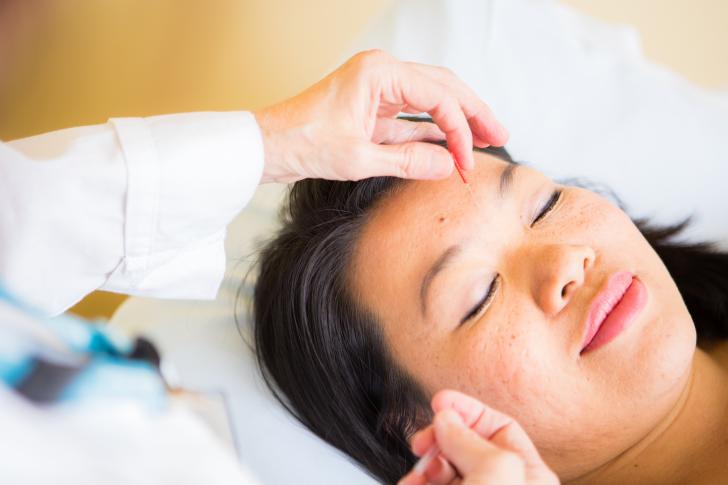 acupuncture on head